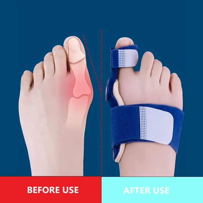 Bunion Corrector I Bunion Splint for Foot Pain Relief and Hallux Valgus I Correction, Day/Night Support